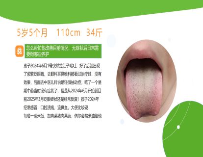 案例一：积食内热眨眼睛